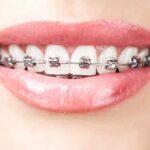 How Can Orthodontic Treatment Help Temporomandibular Disorders (TMD)?